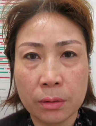 去眼袋手术