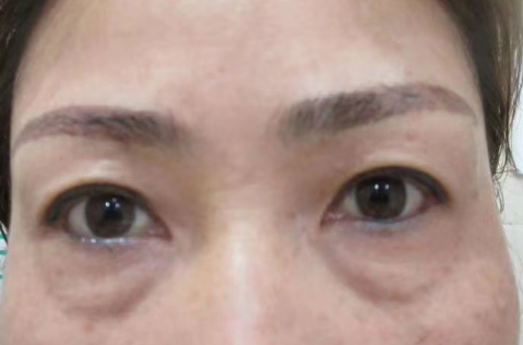 去眼袋手术