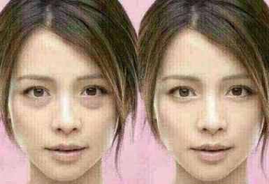 去眼袋手术