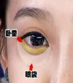 去眼袋手术