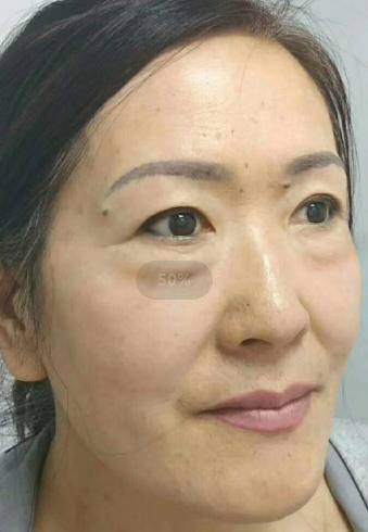 去眼袋手术