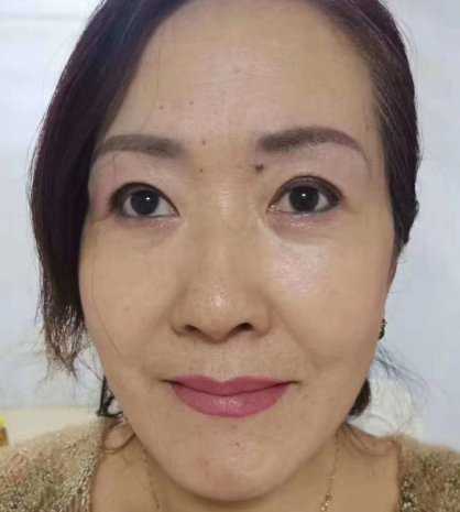 去眼袋手术