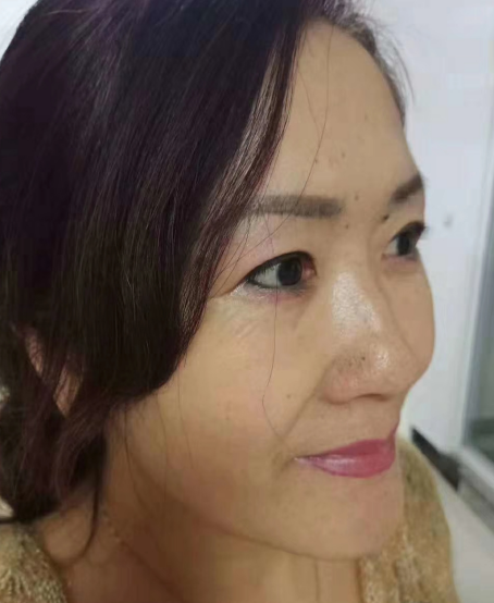 去眼袋手术