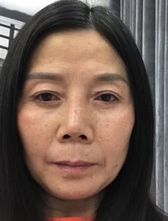 去眼袋手术