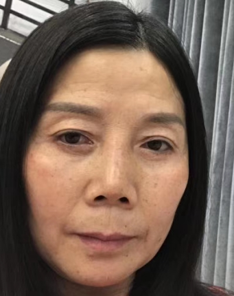 去眼袋手术