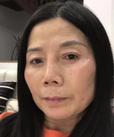 去眼袋手术