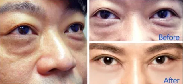 做了去眼袋手术后你害怕浮肿吗?_1296 做了去眼袋手术后你害怕浮肿吗?_1296