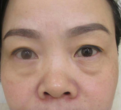 去眼袋手术
