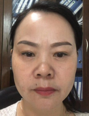 去眼袋手术