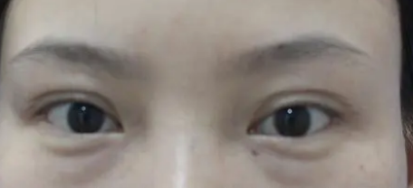 去眼袋手术
