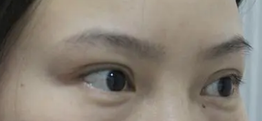 去眼袋手术