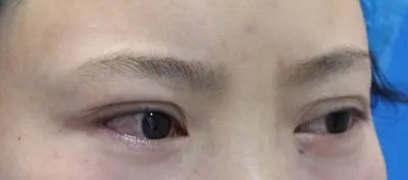 去眼袋手术