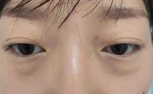 去眼袋手术