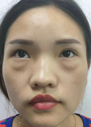 去眼袋手术