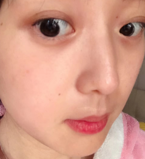 去眼袋手术