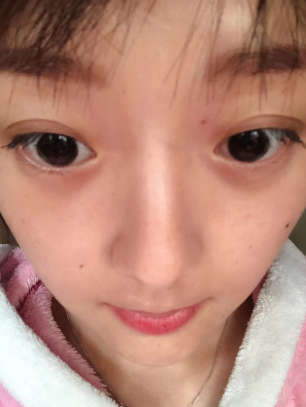 去眼袋手术