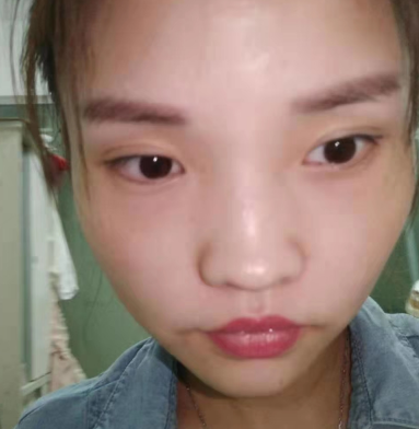去眼袋手术