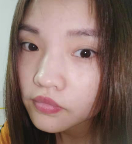 去眼袋手术