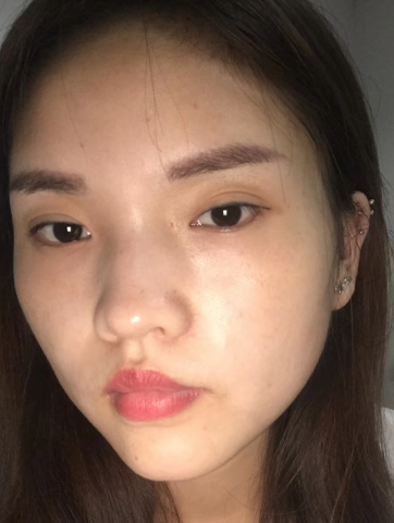 去眼袋手术