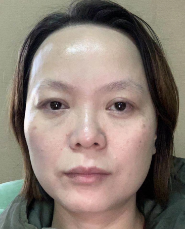 去眼袋手术