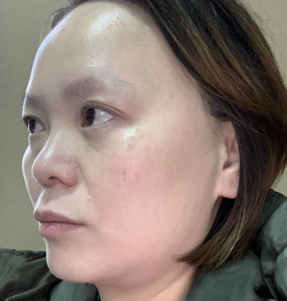 去眼袋手术