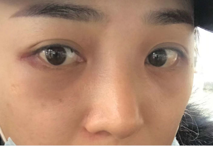 去眼袋手术