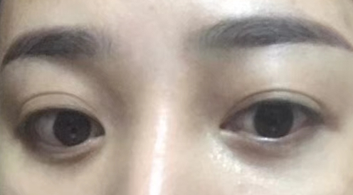 去眼袋手术