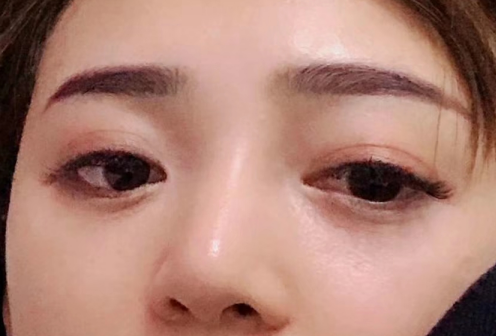 去眼袋手术