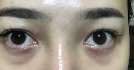 去眼袋手术