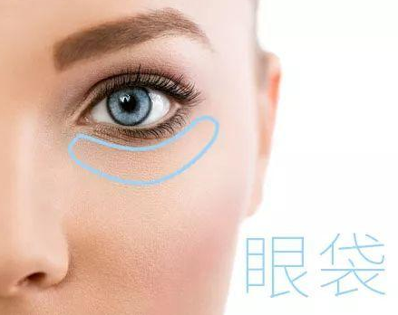 去眼袋手术
