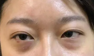 去眼袋手术