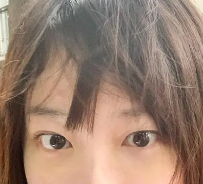 去眼袋手术