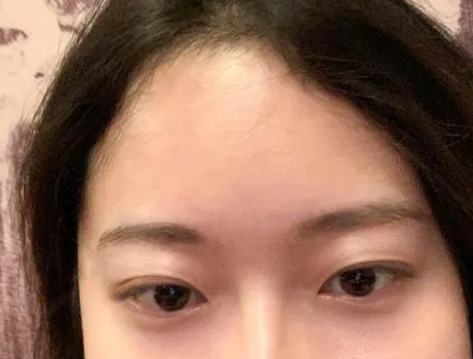 去眼袋手术