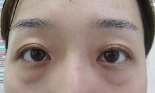 去眼袋手术