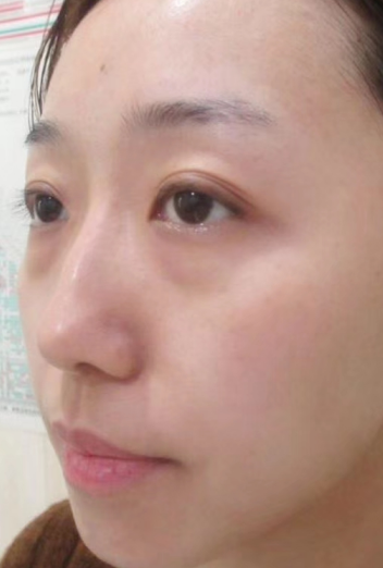 去眼袋手术