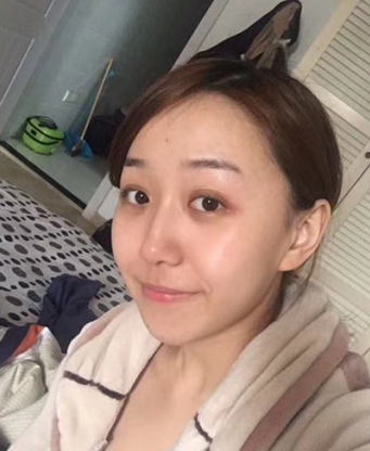 去眼袋手术