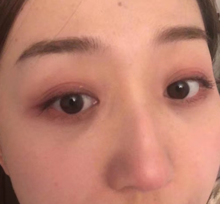 去眼袋手术