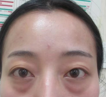去眼袋手术