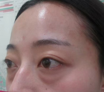去眼袋手术