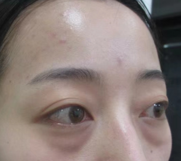 去眼袋手术