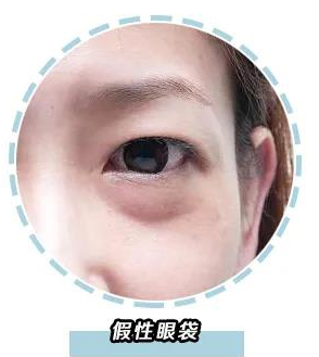 去眼袋手术