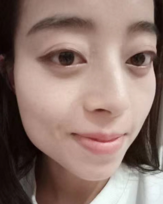 去眼袋手术