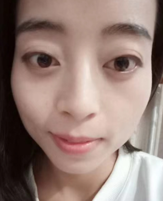 去眼袋手术
