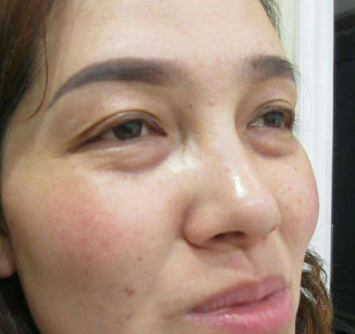在超雅做了眼袋后你是怎么样保养的?900 在超雅做了眼袋后你是怎么样保养的?900