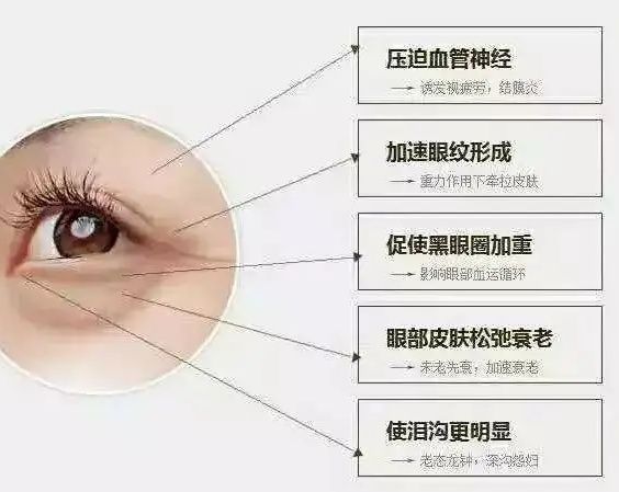 在超雅做了眼袋后你是怎么样保养的?900 在超雅做了眼袋后你是怎么样保养的?900