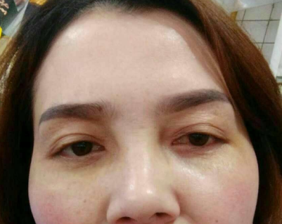 在超雅做了眼袋后你是怎么样保养的?900 在超雅做了眼袋后你是怎么样保养的?900