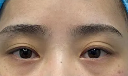 去眼袋手术