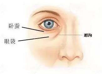 去眼袋手术