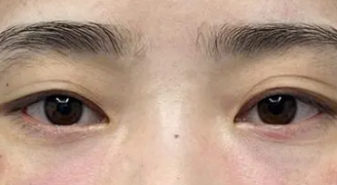 去眼袋手术