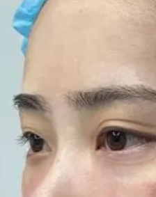 去眼袋手术